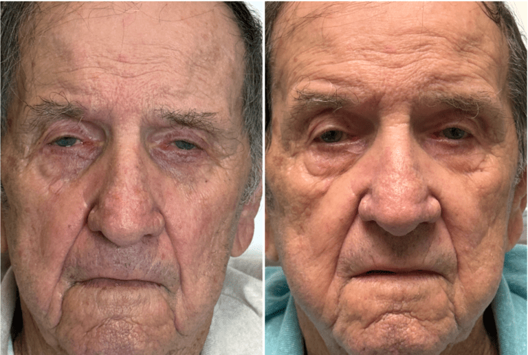 Before and after results of a Lumenis OptiLight IPL treatment for dry eye at MerLeaux Aesthetics and Wellness — frontal view showing reduced eye irritation and redness